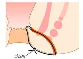 用手肛門拡張術