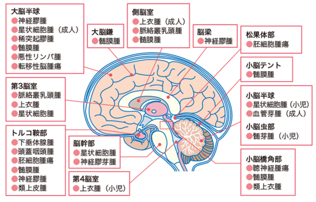 脳腫瘍