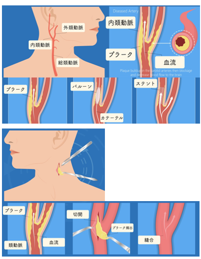 脳梗塞