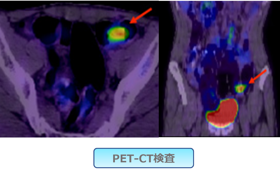 PET-CT検査