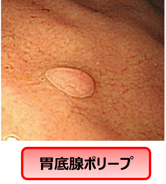 胃底腺ポリープ