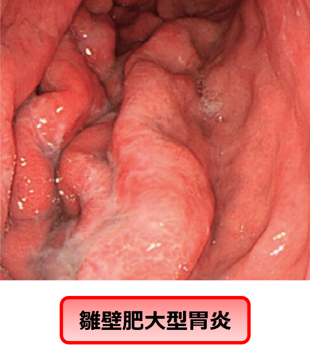 雛壁肥大型胃炎