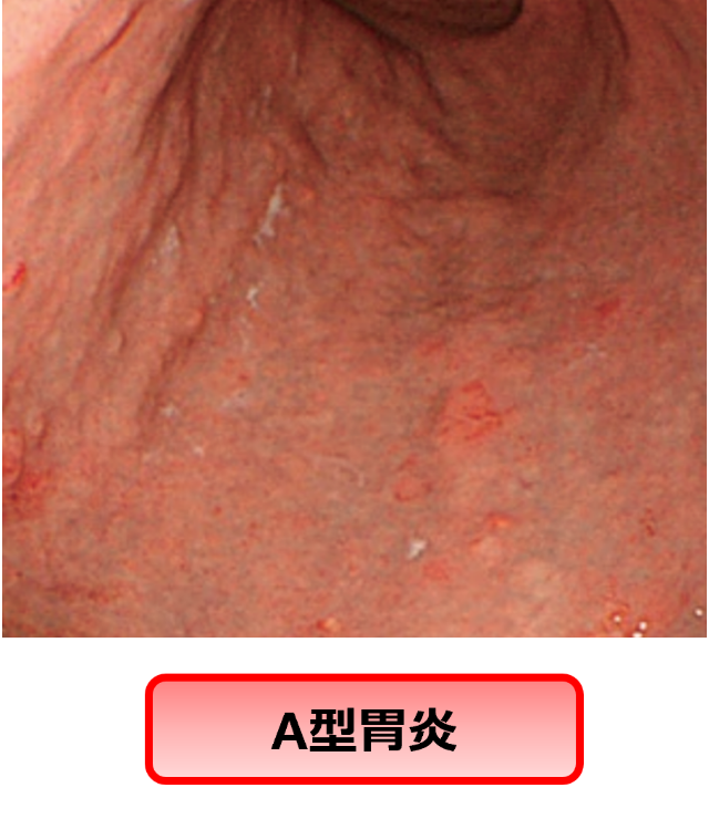 A型胃炎