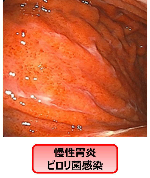 慢性胃炎ピロリ菌感染