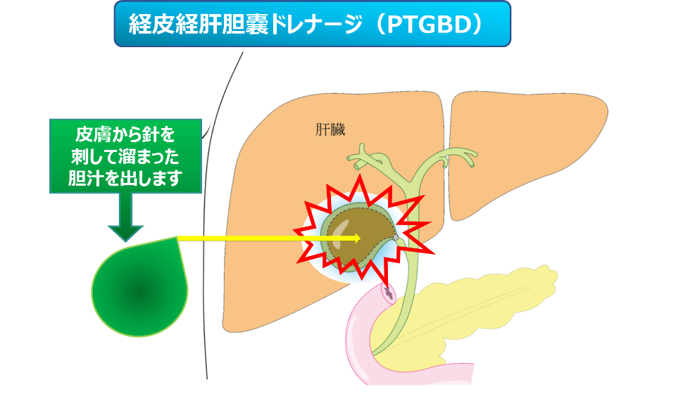経皮経肝胆嚢ドレナージ（PTGBD）
