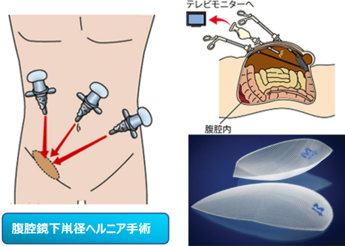 腹腔鏡下鼡径ヘルニア手術（TAPP法）